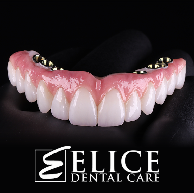 Hybrid Implant Bridge