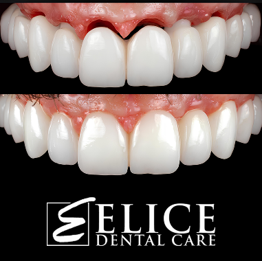 Porcelain Implant Bridge